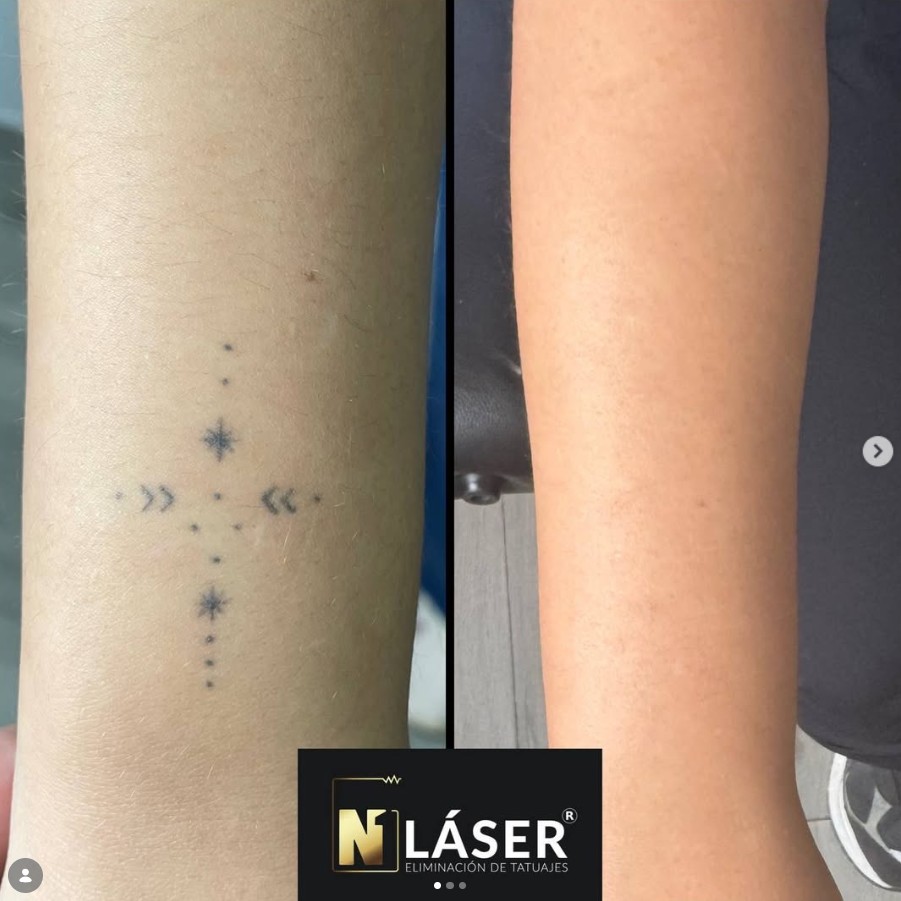 Tratamiento láser realizado por Alex de N1 Laser