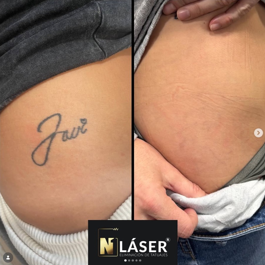 Tratamiento láser realizado por Alex de N1 Laser